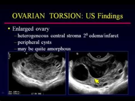 ovarian torsion vs cyst